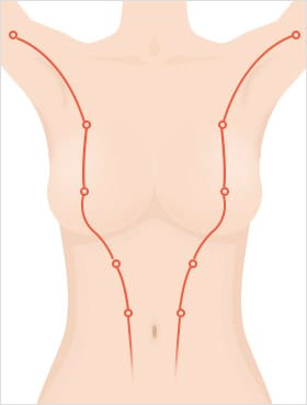 퇴화되어야 할 유선조직이 겨드랑이 및 주변 부위에 남음