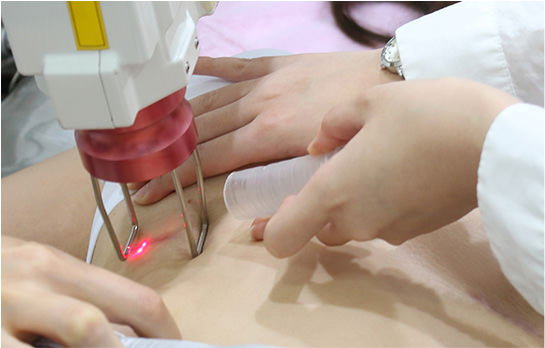 프락셔널 레이저 치료