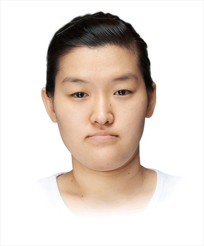 치아를 포함한 아래턱 전체가 길게 전진된 경우 양악 수술 필요