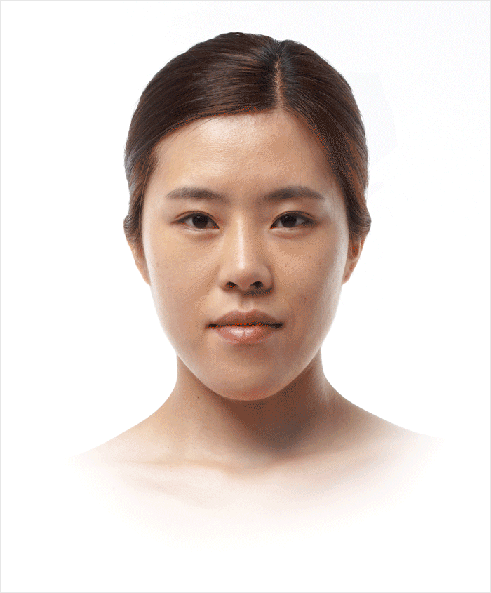 치열의 교합은 정상이고 앞턱이 길게 발달된 경우 앞턱 수술로 개선 가능
