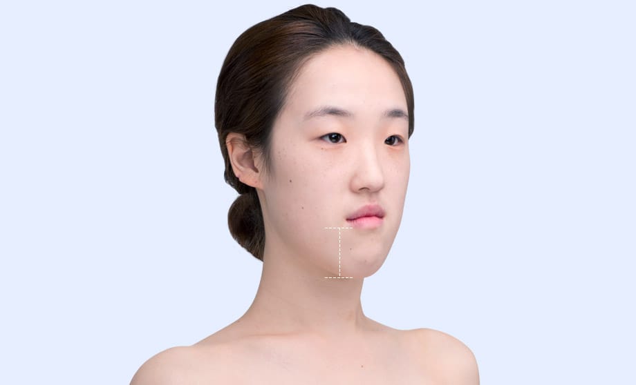 긴 얼굴 양악 수술 성형모델