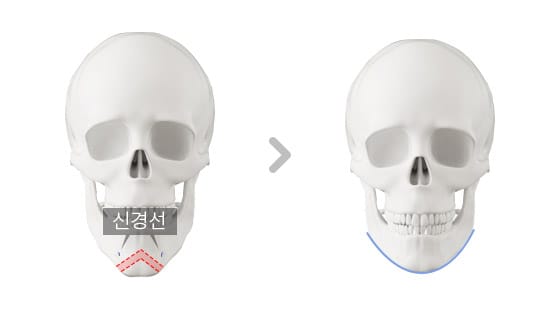 앞턱 수술