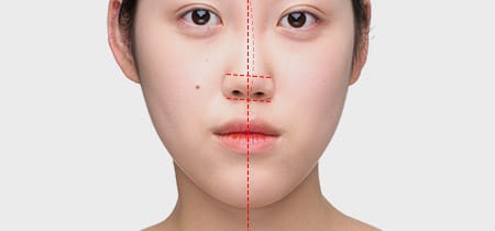 코가 휘어 얼굴이 비대칭으로 보이는 경우