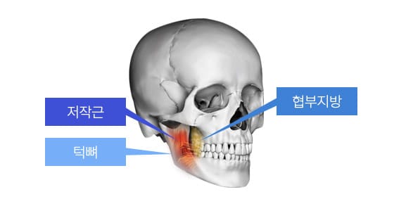 필요한 경우 얼굴 뼈 비대칭으로 인해 비대칭으로 발달한 얼굴 각 층의 조직들 또한 대칭으로 개선