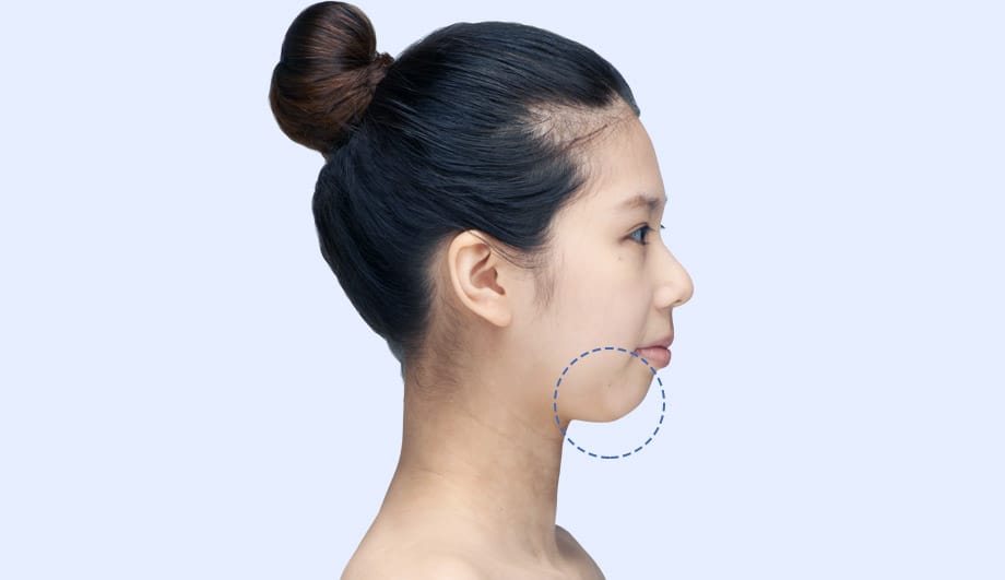 무턱 양악 수술 성형모델