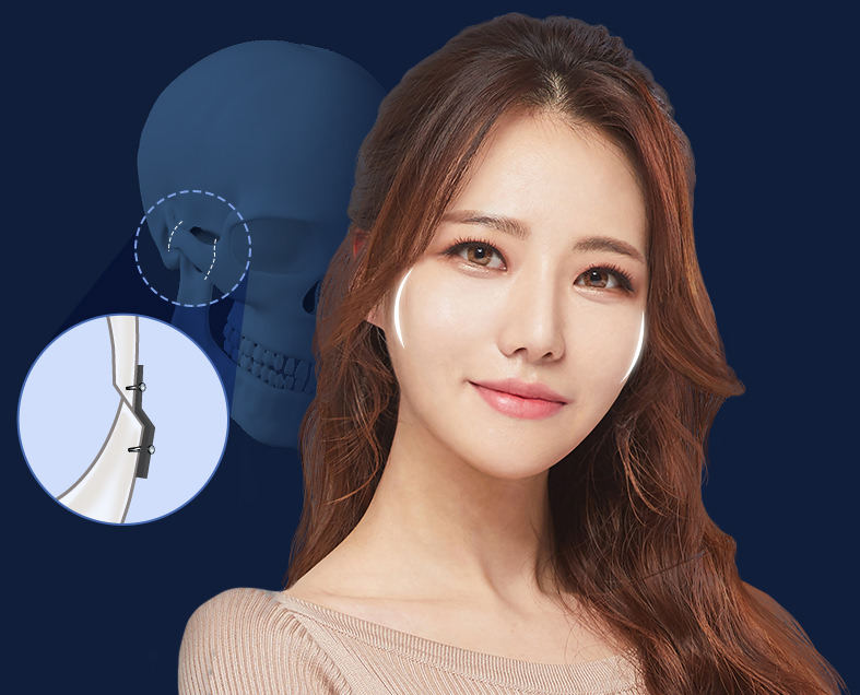 바노바기는 광대궁 복합체 안쪽의 측두근이 주는 힘을 계산하여 광대를 고정합니다.