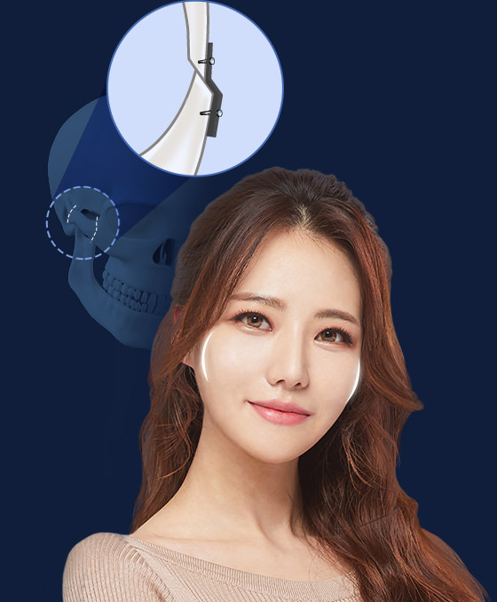 바노바기는 광대궁 복합체 안쪽의 측두근이 주는 힘을 계산하여 광대를 고정합니다.