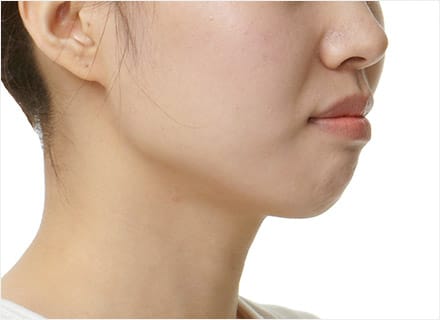 팔자주름이 깊은 돌출입
