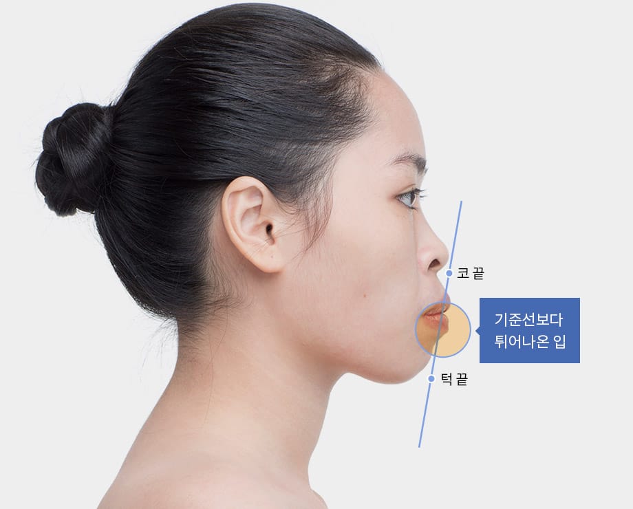 바노바기 돌출입 진단 - 기준선보다 튀어나온 입