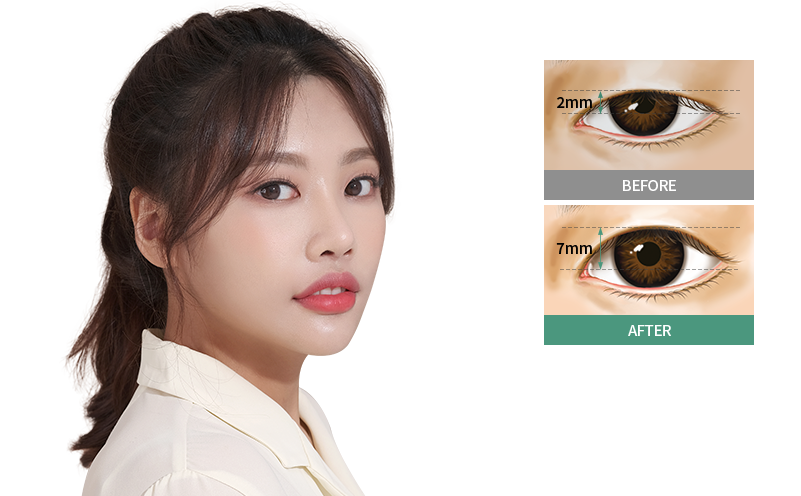 가슴확대수술 보형물