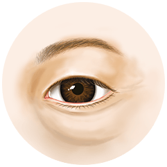 하안검 수술이 필요한 경우