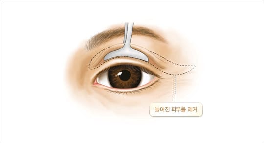 늘어진 피부를 제거