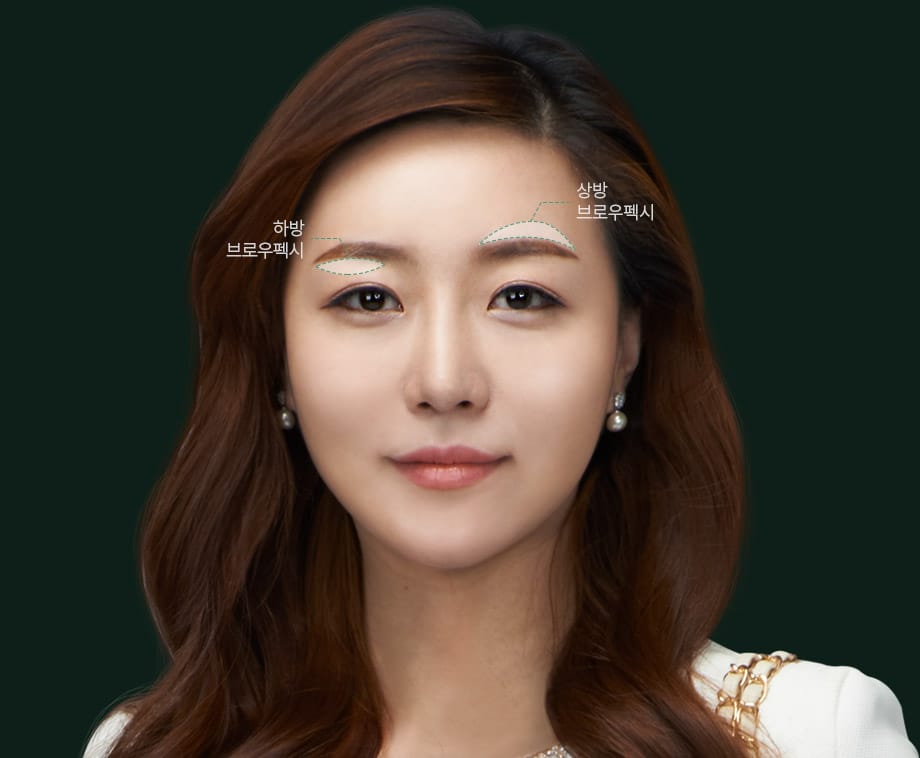 브로우펙시 수술환자