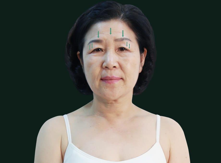 브로우 리프팅 수술환자