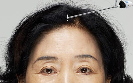 02 내시경을 통해 신경과 혈관의 위치를 확인하면서 처진 이마를 고르게 박리합니다. 