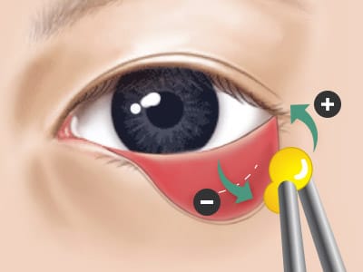 지방제거 또는 이식 - 과도한 지방제거로 근처 지방도 함께 소실되거나, 지방 이식의 경우 이식된 지방의 생착률이 떨어짐.