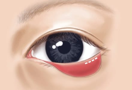 STEP 02 눈 안쪽의 결막을 미세하게 절개합니다. 때문에 일상생활에서 수술 흔적이 거의 보이지 않습니다.