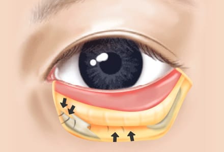 STEP 03 개개인의 눈 모양과 눈 밑 지방의 모양에 맞게 눈 밑 지방을 재배치 합니다.