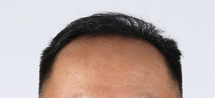 복합형