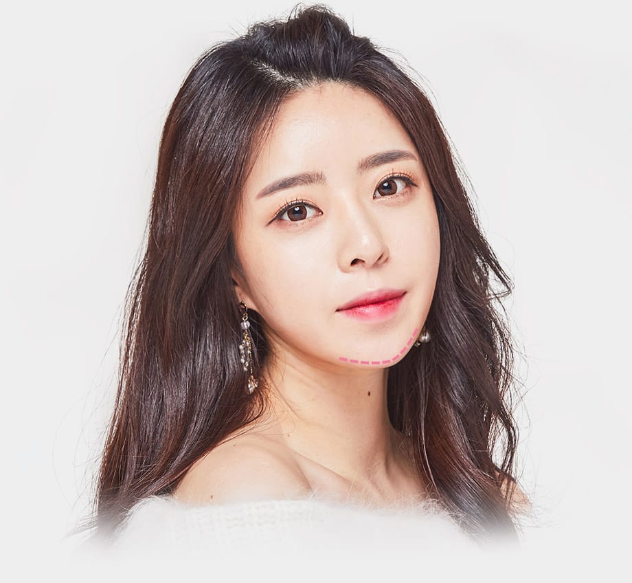 프로화일 성형 : 앞턱