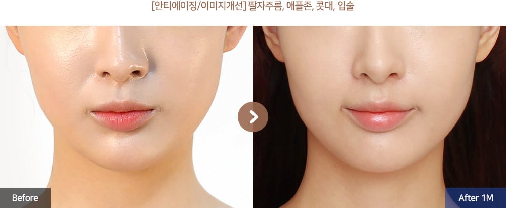 [안티에이징/이미지개선] 팔자주름, 애플존, 콧대