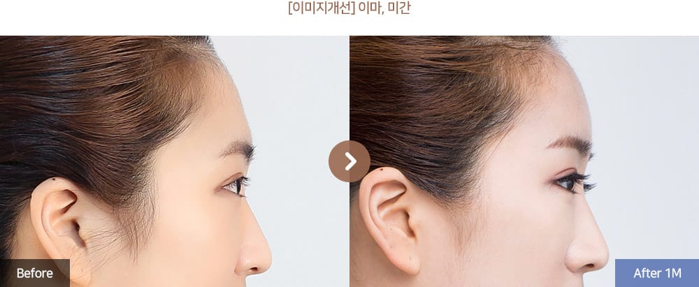 [이미지개선] 이마, 미간