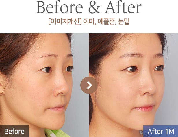 [이미지개선] 이마, 애플존, 눈밑