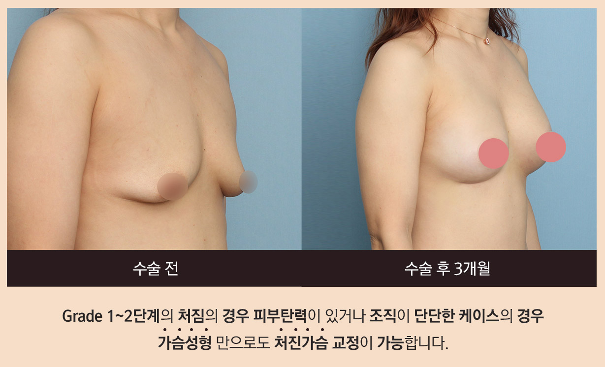 수술 전, 수술 후 3개월 - Grade 1~2단계의 처짐의 경우 피부탄력이 있거나 조직이 단단한 케이스의 경우 가슴성형 만으로도 처진가슴 교정이 가능합니다.