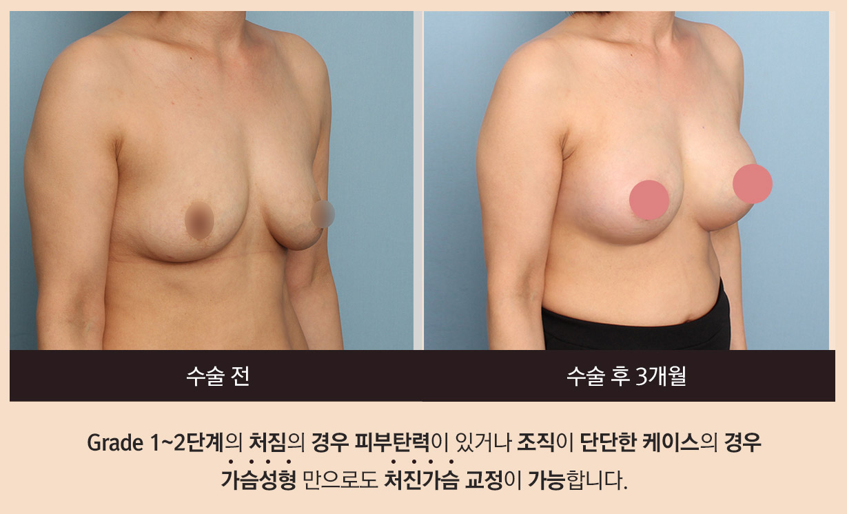 수술 전, 수술 후 3개월 - Grade 1~2단계의 처짐의 경우 피부탄력이 있거나 조직이 단단한 케이스의 경우 가슴성형 만으로도 처진가슴 교정이 가능합니다.