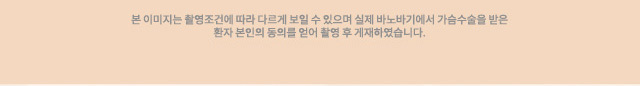 본 이미지는 촬영조건에 따라 다르게 보일 수 있으며 실제 바노바기에서 가슴수술을 받은 환자 본인의 동의를 얻어 촬영 후 게재하였습니다.