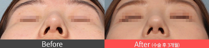 콧대가 휘어져 보이는 경우