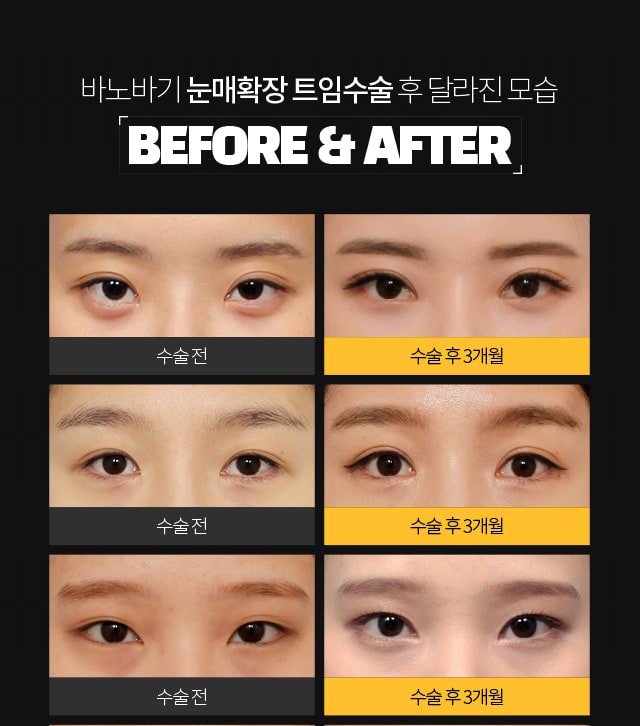 눈매확장 트임 비포 에프터