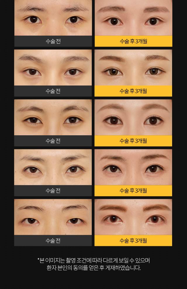 눈매확장 트임 비포 에프터