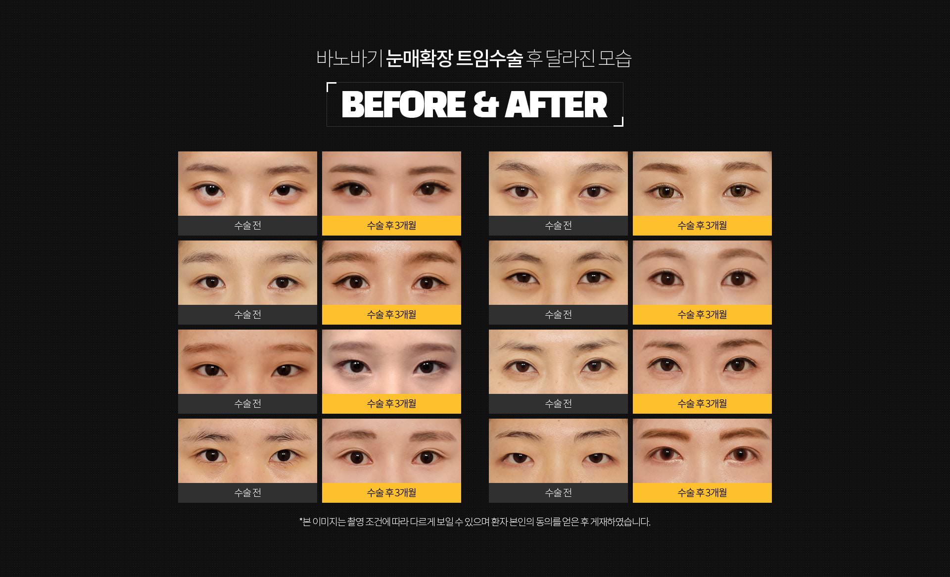 눈매확장 트임 비포 에프터