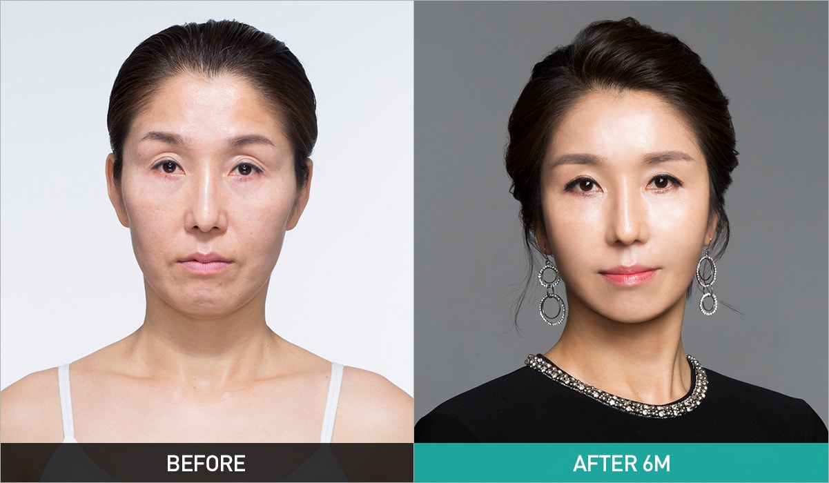 BEFORE & AFTER 6M