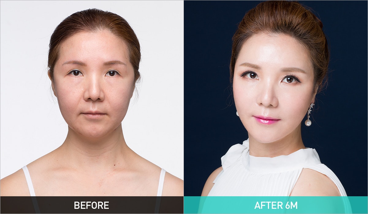 BEFORE & AFTER 6M
