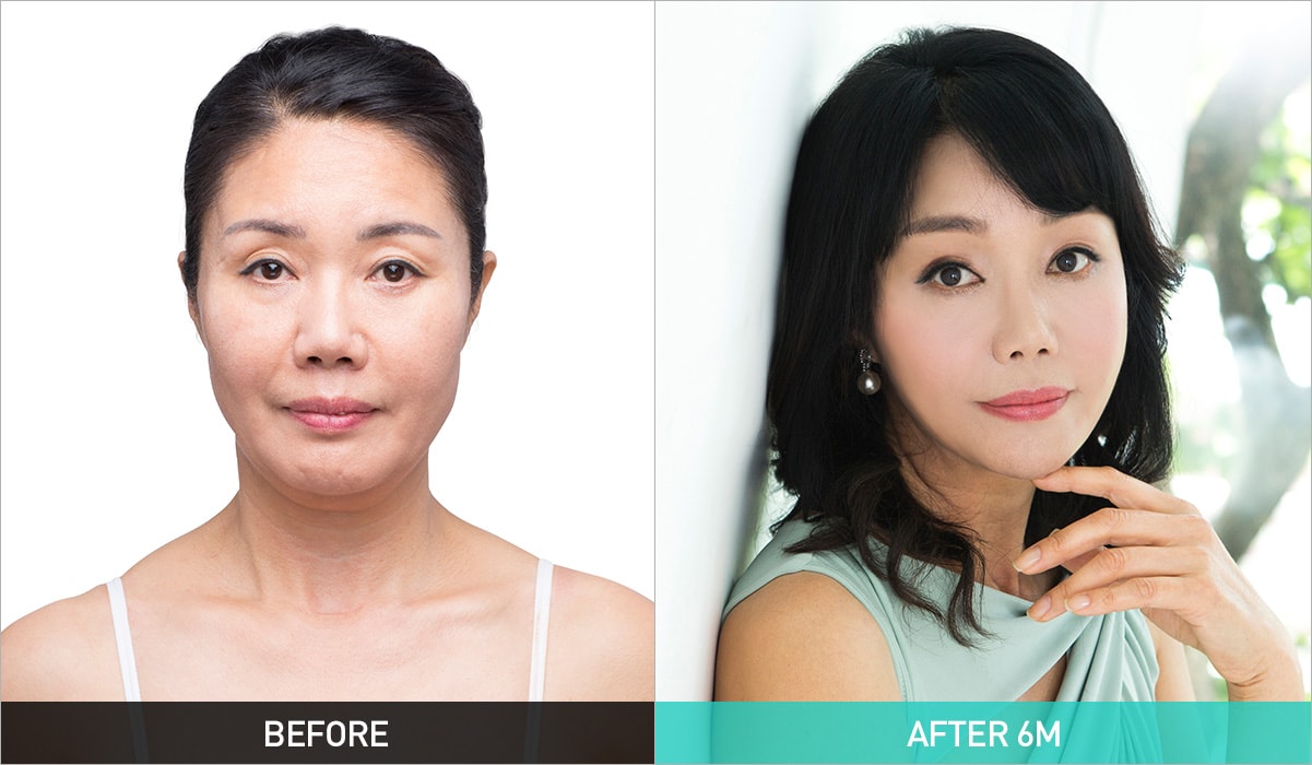 BEFORE & AFTER 6M