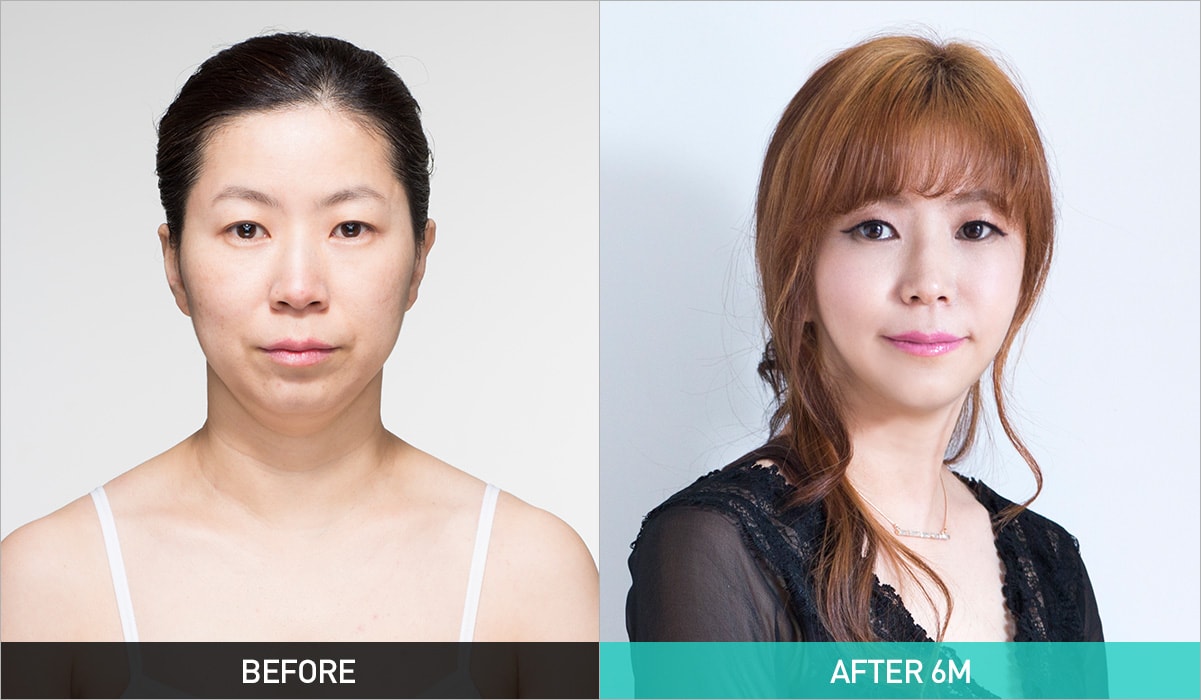BEFORE & AFTER 6M