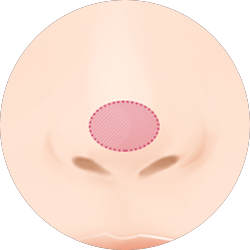 코 끝의 모양이 둔한 경우