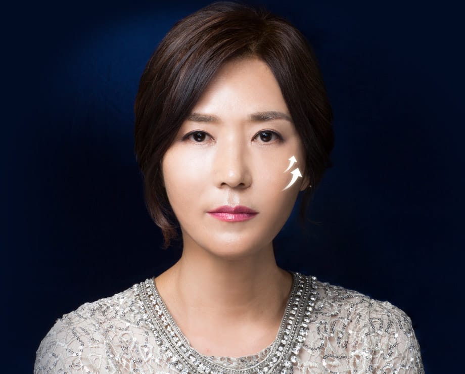 절개 탄력밴드 리프팅 동안 성형 모델