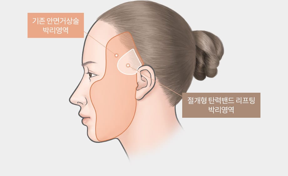 탄력밴드 리프팅(절개) - 기존 안면거상술 박리영역과 절개형 탄력밴드 리프팅 박리영역