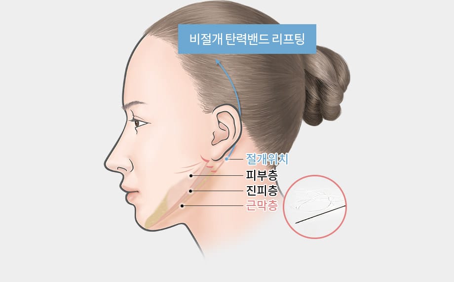 비절개 탄력밴드 리프팅 - 절개위치