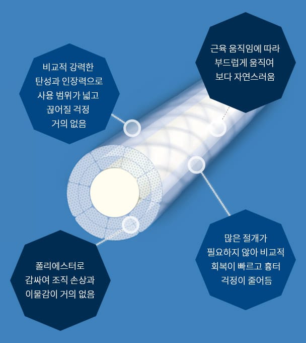 비교적 강력한 탄성과 인장력으로 사용 범위가 넓고 끊어질 걱정 거의 없음, 근육 움직임에 따라 부드럽게 움직여 보다 자연스러움, 폴리에스터로 감싸여 조직 손상과 이물감이 거의 없음, 많은 절개가 필요하지 않아 비교적 회복이 빠르고 흉터 걱정이 줄어듬