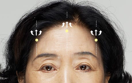 03 두개골이나 심부근막에 엔도타인을 위치 시키고, 눈썹의 위치와 이마주름 등을 고려하여 처진 이마를 당긴 후 엔도타인에 고정시킵니다.
