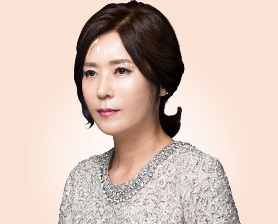 내시경 이마 리프팅의 수술 원리는 비교적 간단합니다. 헤어라인 쪽에 비교적 적은 절개창을 만들어준 후, 처진 이마를 박리하여 당겨주는 것이죠. 당겨진 이마는 엔도타인으로 고르게 고정한 뒤 봉합해줍니다.